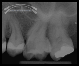 Case of carious pulp exposure tooth 26.