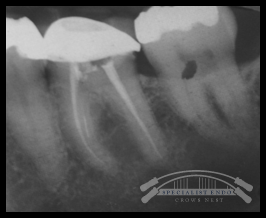 Fractured file in 36 ML canal